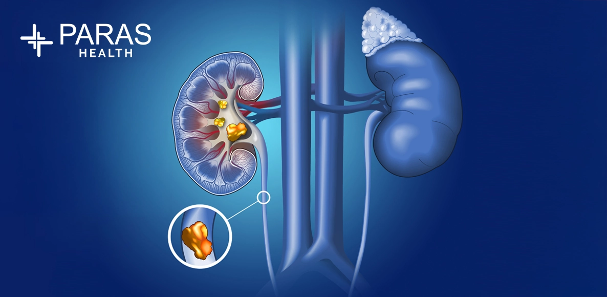 Kidney Stones: A Complete Breakdown of Causes and Symptoms